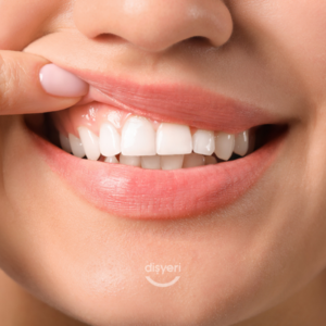 Diş Eti Estetiği