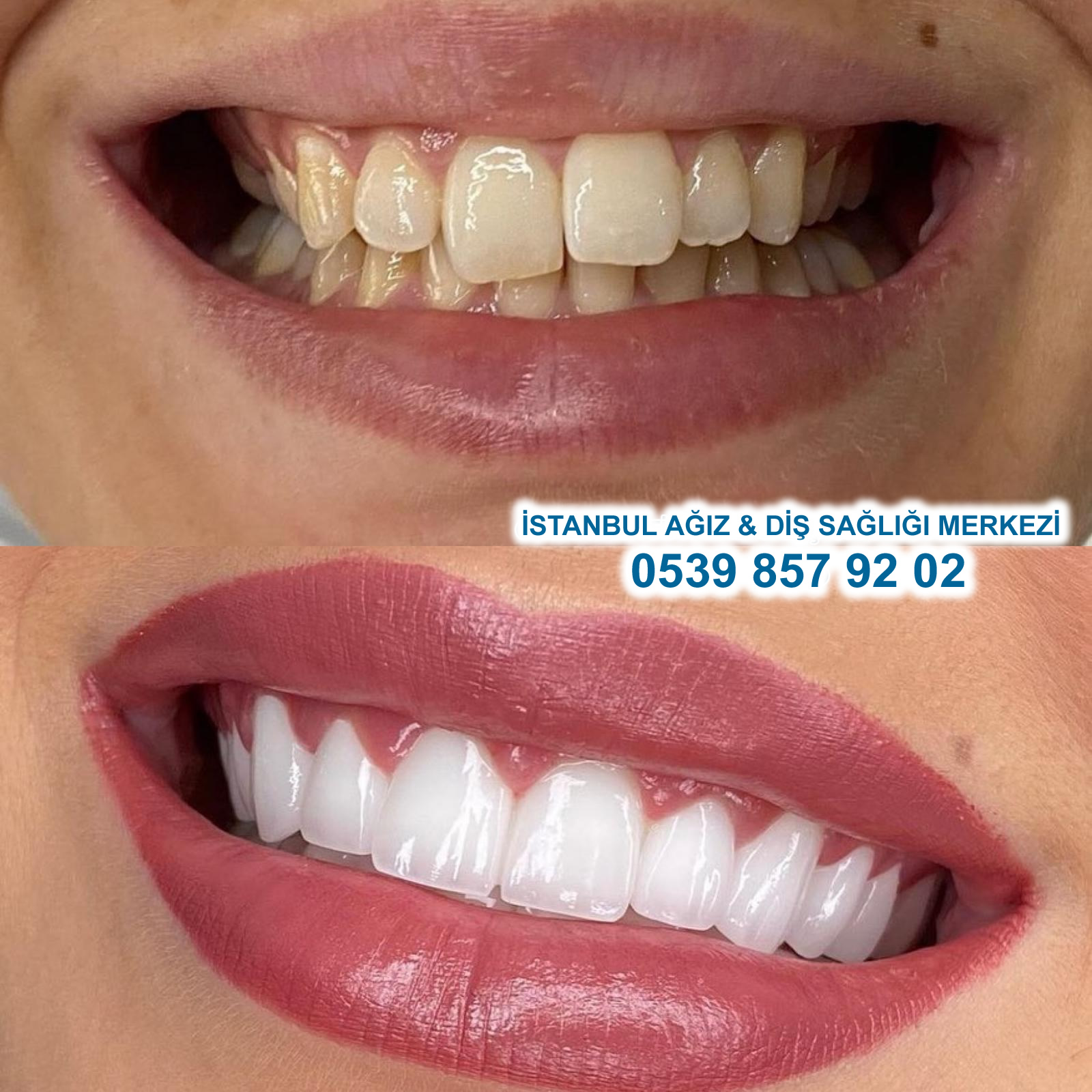 Before After 3