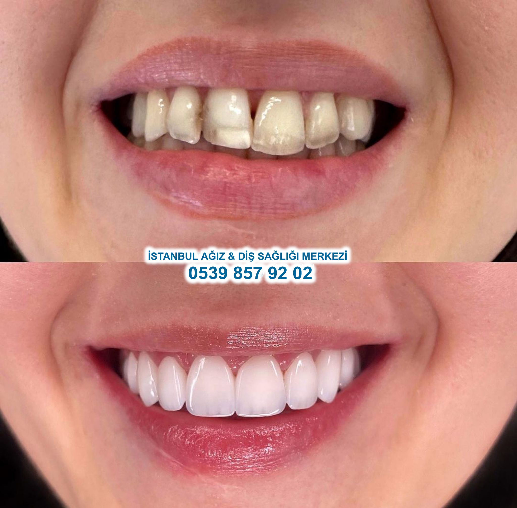 Before After 2