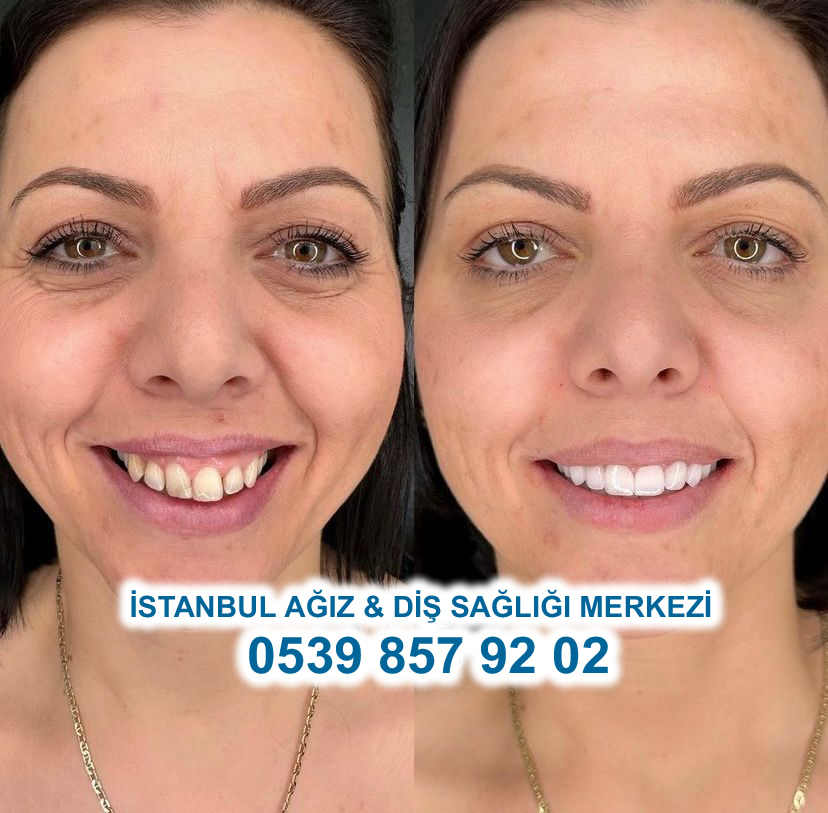 Before After 1
