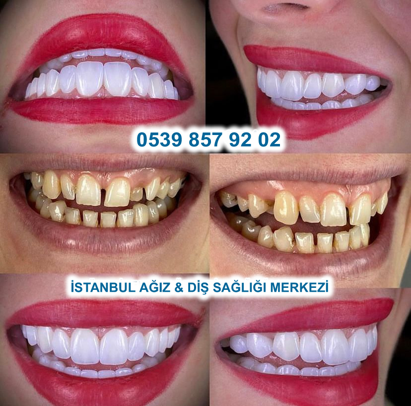Before After 4